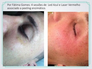 Por Fátima Gomes: 4 sessões de Led Azul e Laser Vermelho
associado a peeling enzimático.
 