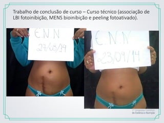 Trabalho de conclusão de curso – Curso técnico (associação de
LBI fotoinibição, MENS bioinibição e peeling fotoativado).
 