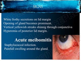 SIGNS
White frothy secretions on lid margin
Opening of gland becomes prominent.
Vertical yellowish streaks shinnig through conjunctiva
Hyperemia of posterior lid margin.
Acute meibomitis
Staphylococcal infection.
Painfull swelling around the gland.
 