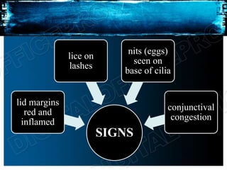 SIGNS
lid margins
red and
inflamed
lice on
lashes
nits (eggs)
seen on
base of cilia
conjunctival
congestion
 