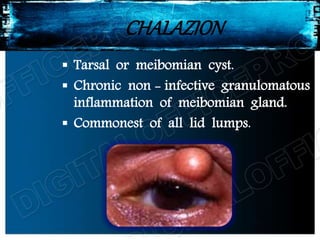 CHALAZION
 Tarsal or meibomian cyst.
 Chronic non - infective granulomatous
inflammation of meibomian gland.
 Commonest of all lid lumps.
 