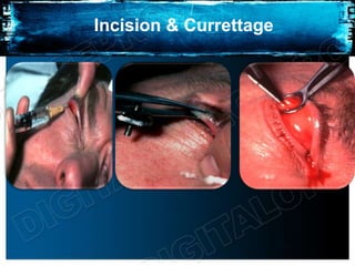 Incision & Currettage
 