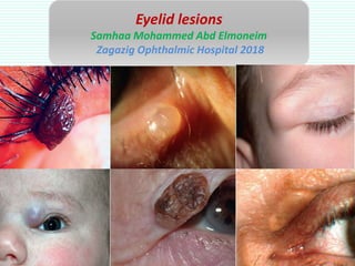 Eyelid lesions
Samhaa Mohammed Abd Elmoneim
Zagazig Ophthalmic Hospital 2018
 