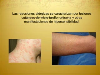Las reacciones alérgicas se caracterizan por lesiones
cutáneas de inicio tardío, urticaria y otras
manifestaciones de hipersensibilidad.
 