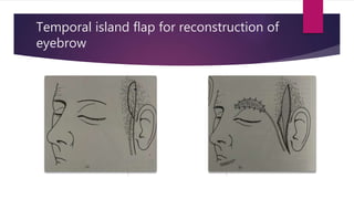 Temporal island flap for reconstruction of
eyebrow
 