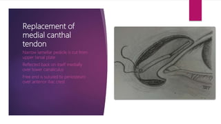 Replacement of
medial canthal
tendon
Narrow lamellar pedicle is cut from
upper tarsal plate
Reflected back on itself medially
over lower canaliculus
Free end is sutured to periosteum
over anterior iliac crest
 
