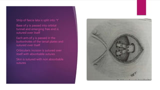 Strip of fascia lata is split into ‘Y’
Base of y is passed into orbital
tunnel and emerging free end is
sutured over itself
Each arm of y is passed in the
buttonholes of the tarsal plates and
sutured over itself
Orbicularis incision is sutured over
itself with absorbable sutures
Skin is sutured with non absorbable
sutures
 