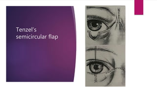 Tenzel’s
semicircular flap
 