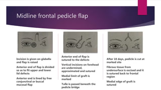 Midline frontal pedicle flap
Incision is given on glabella
and flap is raised
Anterior end of flap is divided
so as to fit upper and lower
lid defects
Anterior end is lined by free
conjunctival or buccal
mucosal flap
Anterior end of flap is
sutured to the defects
Vertical incisions on forehead
are undermined,
approximated and sutured
Medial limit of graft is
marked
Tulle is passed beneath the
pedicle bridge
After 18 days, pedicle is cut at
marked site
Fibrous tissue from
undersurface is excised and it
is sutured back to frontal
region
Medial edge of graft is
sutured
 