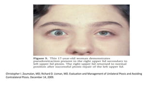 Christopher I. Zoumalan, MD; Richard D. Lisman, MD. Evaluation and Management of Unilateral Ptosis and Avoiding
Contralateral Ptosis. December 14, 2009.
 