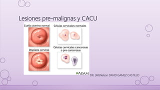 Lesiones pre-malignas y CACU
DR. (MI)Nelson DAVID GAMEZ CASTILLO
 