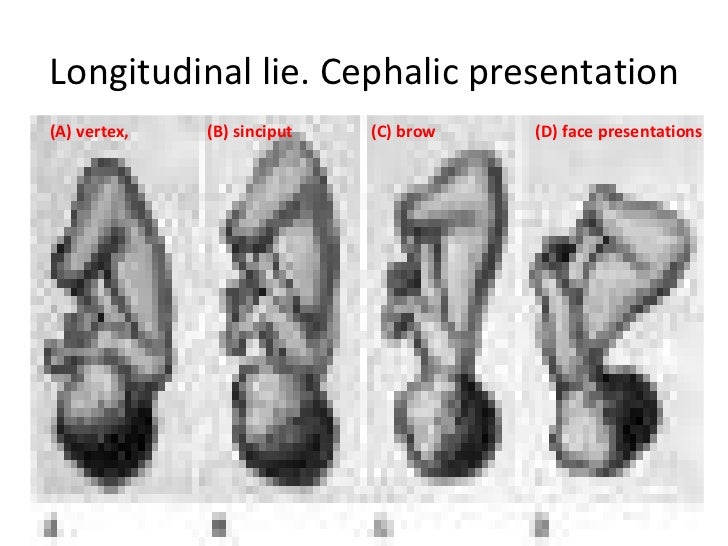 presentation lie cephalic