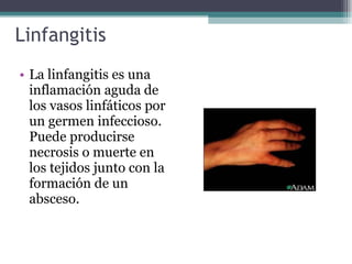 Linfangitis Reticular Lifatico | PPT