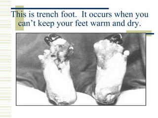 This is trench foot. It occurs when you
can’t keep your feet warm and dry.
 