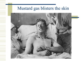 Mustard gas blisters the skin
 
