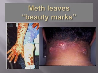 Meth leaves“beauty marks”