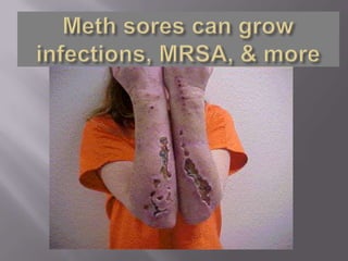 Meth sores can grow infections, MRSA, & more