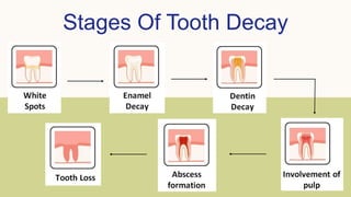 Stages Of Tooth Decay
 