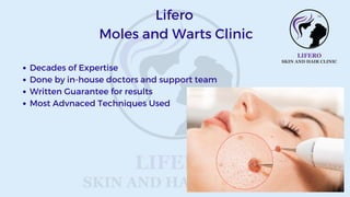 Decades of Expertise
Done by in-house doctors and support team
Written Guarantee for results
Most Advnaced Techniques Used
Lifero
Moles and Warts Clinic
 