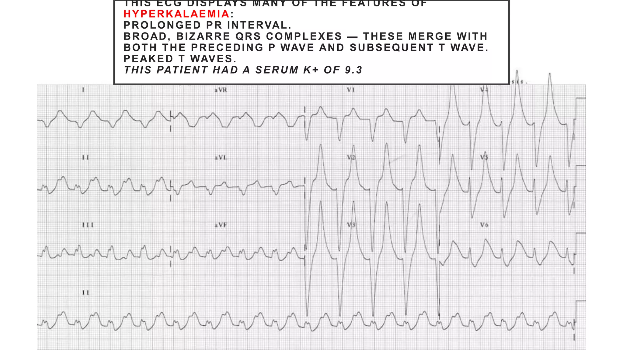 THIS ECG DISPLAYS MANY OF THE FEATURES OF
HYPERKALAEMIA:
PROLONGED PR INTERVAL.
BROAD, BIZARRE QRS COMPLEXES — THESE MERGE WITH
BOTH THE PRECEDING P WAVE AND SUBSEQUENT T WAVE.
PEAKED T WAVES.
THIS PATIENT HAD A SERUM K+ OF 9.3
 