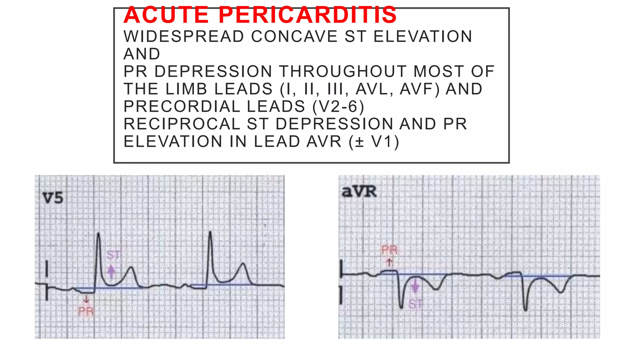 ACUTE PERICARDITIS
WIDESPREAD CONCAVE ST ELEVATION
AND
PR DEPRESSION THROUGHOUT MOST OF
THE LIMB LEADS (I, II, III, AVL, AVF) AND
PRECORDIAL LEADS (V2-6)
RECIPROCAL ST DEPRESSION AND PR
ELEVATION IN LEAD AVR (± V1)
 