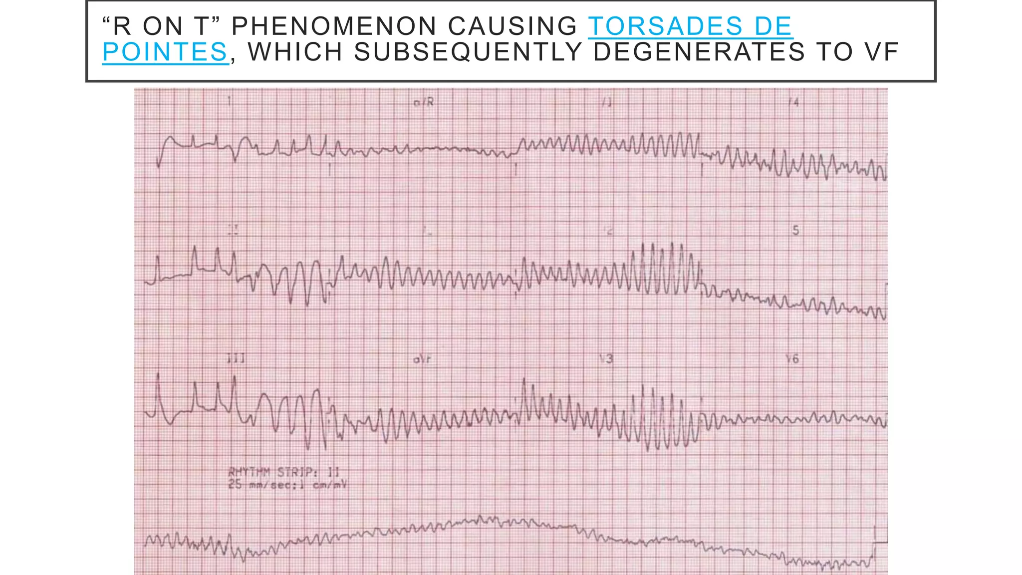 “R ON T” PHENOMENON CAUSING TORSADES DE
POINTES, WHICH SUBSEQUENTLY DEGENERATES TO VF
 