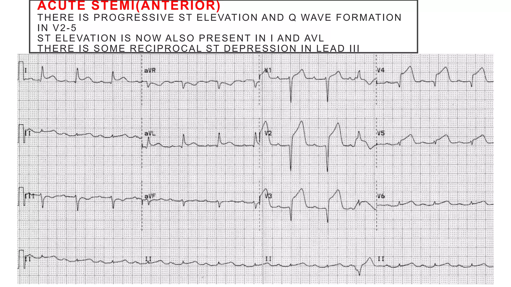 ACUTE STEMI(ANTERIOR)
THERE IS PROGRESSIVE ST ELEVATION AND Q WAVE FORMATION
IN V2-5
ST ELEVATION IS NOW ALSO PRESENT IN I AND AVL
THERE IS SOME RECIPROCAL ST DEPRESSION IN LEAD III
 