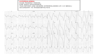 HYPERKALAEM IA:
HUGE PEAKED T WAVES.
SINE WAVE APPEARANCE.
THIS PATIENT HAD SEVERE HYPERKALAEMIA (K+ 9.0 MEQ/L)
SECONDARY TO RHABDOMYOLYSIS.
 