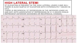 HIGH LATERAL STEMI
ST ELEVATION IS PRESENT IN THE HIGH LATERAL LEADS (I AND AVL).
THERE IS ALSO SUBTLE ST ELEVATION WITH HYPERACUTE T WAVES IN
V5-6.
THERE IS RECIPROCAL ST DEPRESSION IN THE INFERIOR LEADS (III
AND AVF) WITH ASSOCIATED ST DEPRESSION IN V1 -3 (WHICH COULD
REPRESENT ANTERIOR ISCHAEMIA OR RECIPROCAL CHANGE).
 
