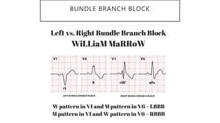 BUNDLE BRANCH BLOCK
 