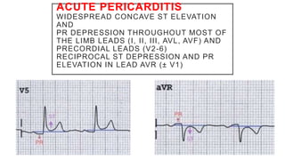 ACUTE PERICARDITIS
WIDESPREAD CONCAVE ST ELEVATION
AND
PR DEPRESSION THROUGHOUT MOST OF
THE LIMB LEADS (I, II, III, AVL, AVF) AND
PRECORDIAL LEADS (V2-6)
RECIPROCAL ST DEPRESSION AND PR
ELEVATION IN LEAD AVR (± V1)
 