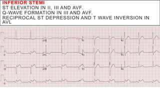 INFERIOR STEMI
ST ELEVATION IN II, III AND AVF.
Q-WAVE FORMATION IN III AND AVF.
RECIPROCAL ST DEPRESSION AND T WAVE INVERSION IN
AVL
 