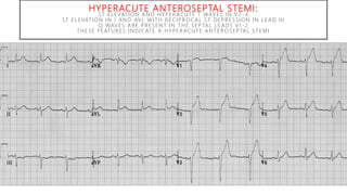 HYPERACUTE ANTEROSEPTAL STEMI:
ST ELEVATION AND HYPERACUTE T WAVES IN V2 -4
ST ELEVATION IN I AND AVL WITH RECIPROCAL ST DEPRESSION IN LEAD III
Q WAVES ARE PRESENT IN THE SEPTAL LEADS V1 -2
THESE FEATURES INDICATE A HYPERACUTE ANTEROSEPTAL STEMI
 