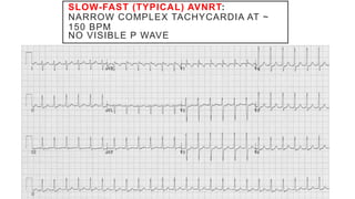 SLOW-FAST (TYPICAL) AVNRT:
NARROW COMPLEX TACHYCARDIA AT ~
150 BPM
NO VISIBLE P WAVE
 