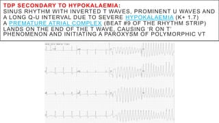 TDP SECONDARY TO HYPOKALAEMIA:
SINUS RHYTHM WITH INVERTED T WAVES, PROMINENT U WAVES AND
A LONG Q-U INTERVAL DUE TO SEVERE HYPOKALAEMIA (K+ 1.7)
A PREMATURE ATRIAL COMPLEX (BEAT #9 OF THE RHYTHM STRIP)
LANDS ON THE END OF THE T WAVE, CAUSING ‘R ON T’
PHENOMENON AND INITIATING A PAROXYSM OF POLYMORPHIC VT
 
