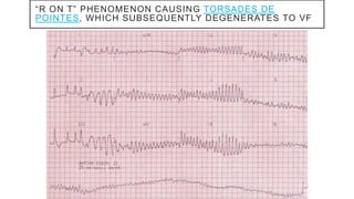 “R ON T” PHENOMENON CAUSING TORSADES DE
POINTES, WHICH SUBSEQUENTLY DEGENERATES TO VF
 