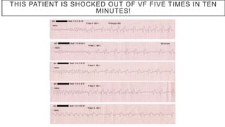 THIS PATIENT IS SHOCKED OUT OF VF FIVE TIMES IN TEN
MINUTES!
 