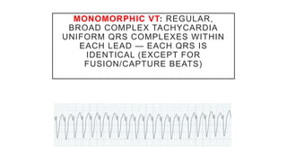 MONOMORPHIC VT: REGULAR,
BROAD COMPLEX TACHYCARDIA
UNIFORM QRS COMPLEXES WITHIN
EACH LEAD — EACH QRS IS
IDENTICAL (EXCEPT FOR
FUSION/CAPTURE BEATS)
 