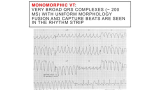 MONOMORPHIC VT:
VERY BROAD QRS COMPLEXES (~ 200
MS) WITH UNIFORM MORPHOLOGY
FUSION AND CAPTURE BEATS ARE SEEN
IN THE RHYTHM STRIP
 