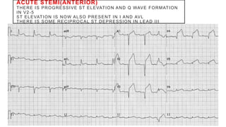 ACUTE STEMI(ANTERIOR)
THERE IS PROGRESSIVE ST ELEVATION AND Q WAVE FORMATION
IN V2-5
ST ELEVATION IS NOW ALSO PRESENT IN I AND AVL
THERE IS SOME RECIPROCAL ST DEPRESSION IN LEAD III
 