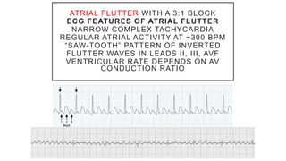 ATRIAL FLUTTER WITH A 3:1 BLOCK
ECG FEATURES OF ATRIAL FLUTTER
NARROW COMPLEX TACHYCARDIA
REGULAR ATRIAL ACTIVITY AT ~300 BPM
“SAW-TOOTH” PATTERN OF INVERTED
FLUTTER WAVES IN LEADS II, III, AVF
VENTRICULAR RATE DEPENDS ON AV
CONDUCTION RATIO
 