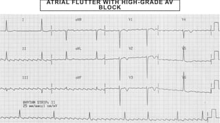 ATRIAL FLUTTER WITH HIGH-GRADE AV
BLOCK
 