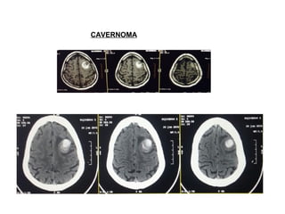 Life saving neurosurgery - | PPT