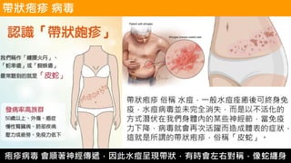 帶狀疱疹 俗稱 水痘，一般水痘痊癒後可終身免
疫，水痘病毒並未完全消失，而是以不活化的
方式潛伏在我們身體內的某些神經節，當免疫
力下降，病毒就會再次活躍而造成體表的症狀，
這就是所謂的帶狀疱疹，俗稱「皮蛇」。
帶狀疱疹 病毒
疱疹病毒 會順著神經傳遞，因此水痘呈現帶狀，有時會左右對稱，像蛇纏身
 