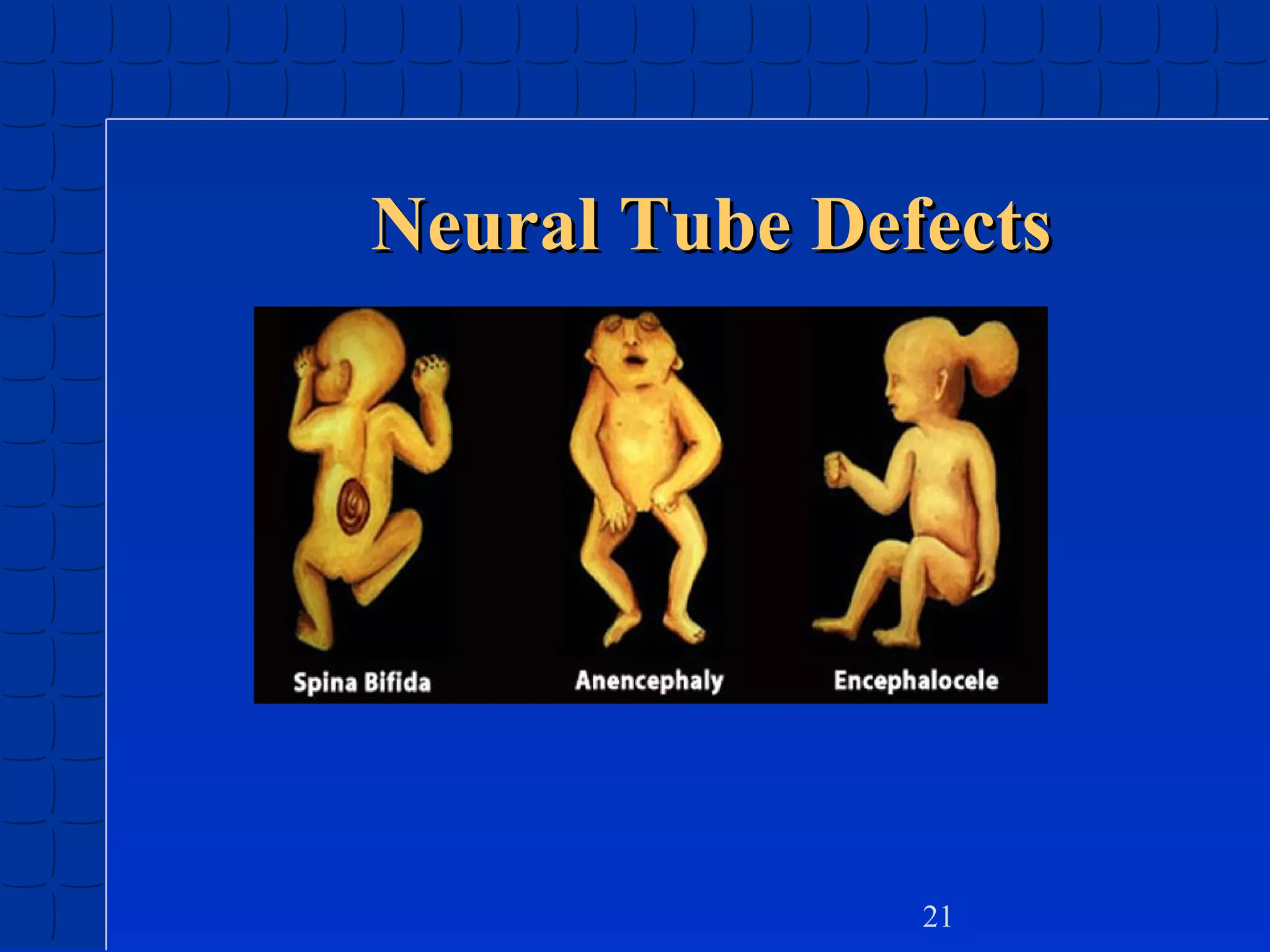 Neural Tube Defects

21

 