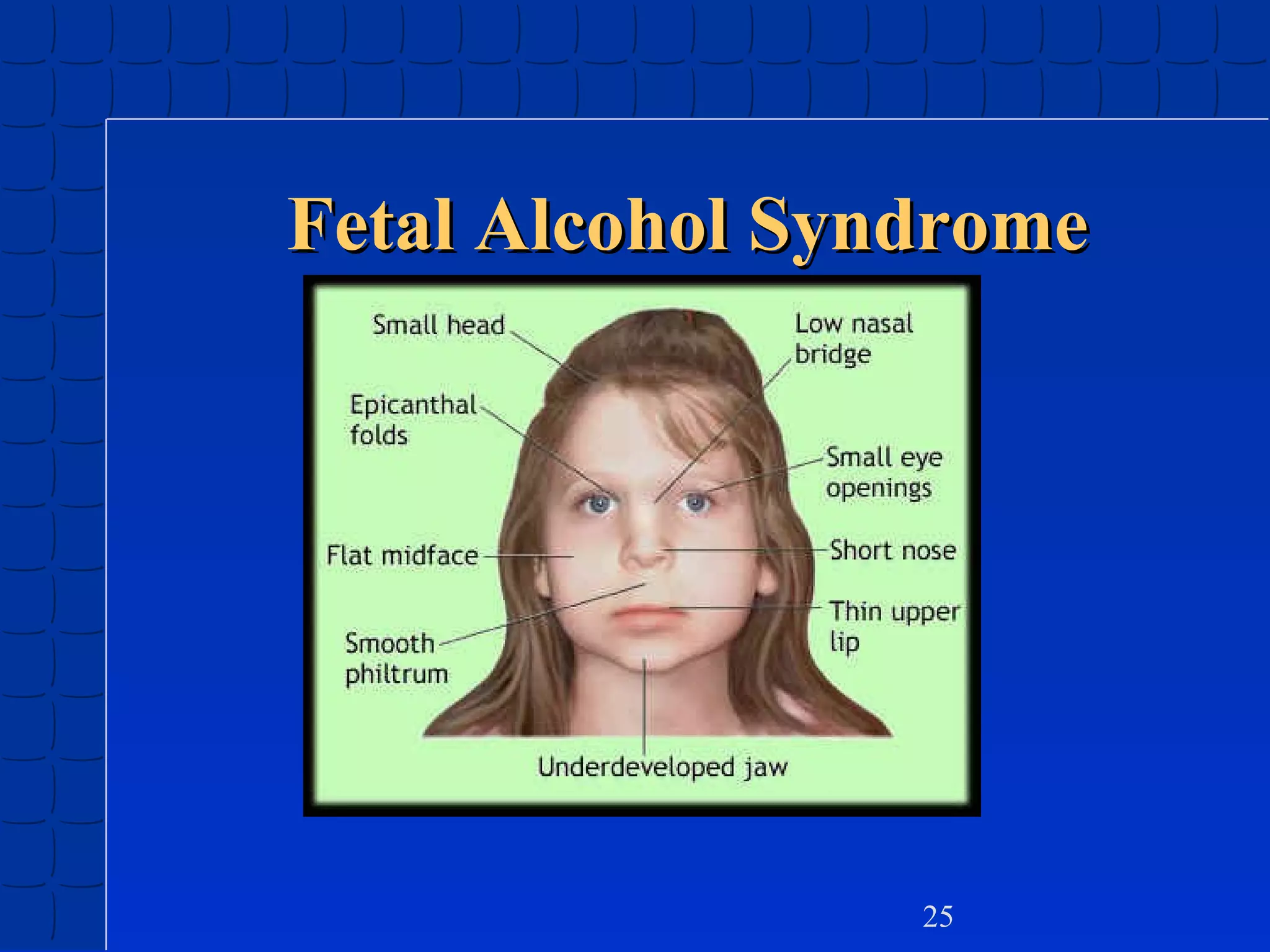 Fetal Alcohol Syndrome

25

 