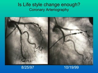 Is Life style change enough?
     Coronary Arteriography




 8/25/97                10/19/99
 