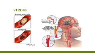 ROLE OF PHYSIOTHERAPY IN PREVENTION OF
STROKE
▪ Stroke -cerebrovascular accident- insulting the brain’s motor
and sensory ...