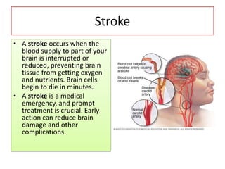 Stroke
• A stroke occurs when the
blood supply to part of your
brain is interrupted or
reduced, preventing brain
tissue from getting oxygen
and nutrients. Brain cells
begin to die in minutes.
• A stroke is a medical
emergency, and prompt
treatment is crucial. Early
action can reduce brain
damage and other
complications.
 