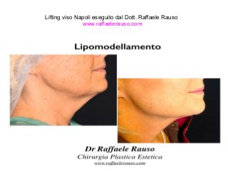 Lifting viso Napoli eseguito dal Dott. Raffaele Rauso 
www.raffaelerauso.com 
 
